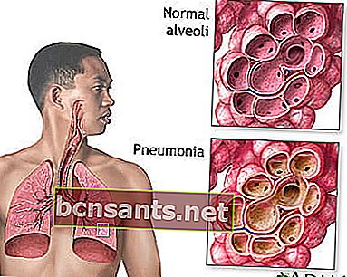 la polmonite è
